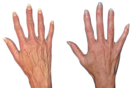 Effect of Neoveris for the treatment of hand varicose veins