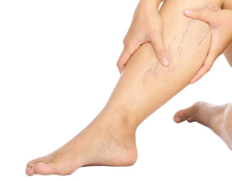 How to cure varicose veins with Neoveris