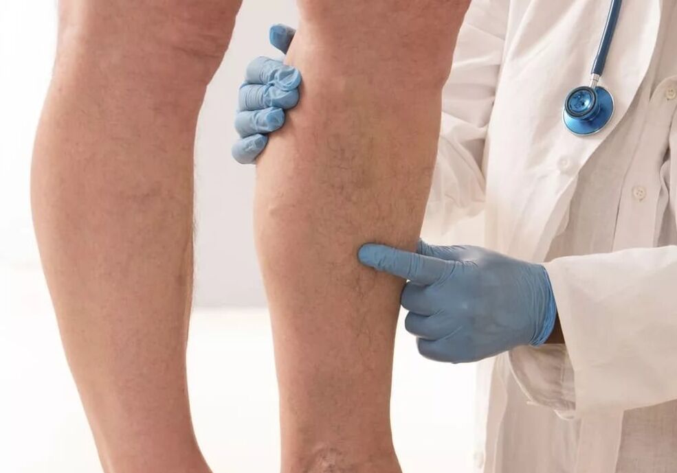 Varice treatment