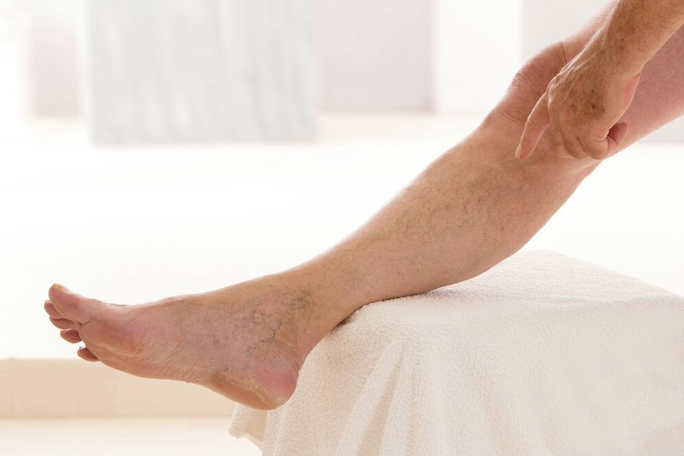 Varices on the legs